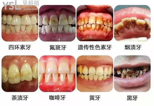 黄牙图片-黄牙有吸引力？牙医告诉你真相